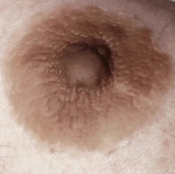 GenderMender Prosthetic Nipples for Men. Women and Non-Binary in over 100 skin-tones